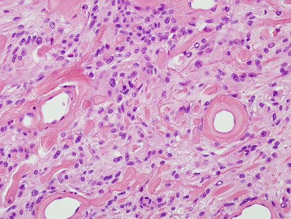 11B8 Meningioma (Case 11) H&E 7