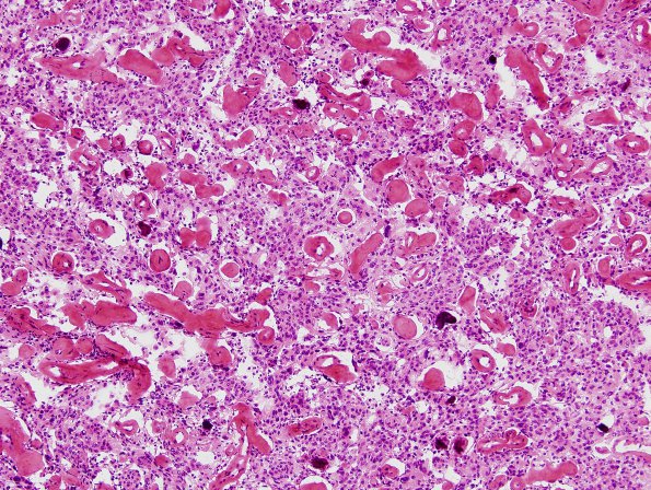 11B8 Meningioma (Case 11) H&E 8