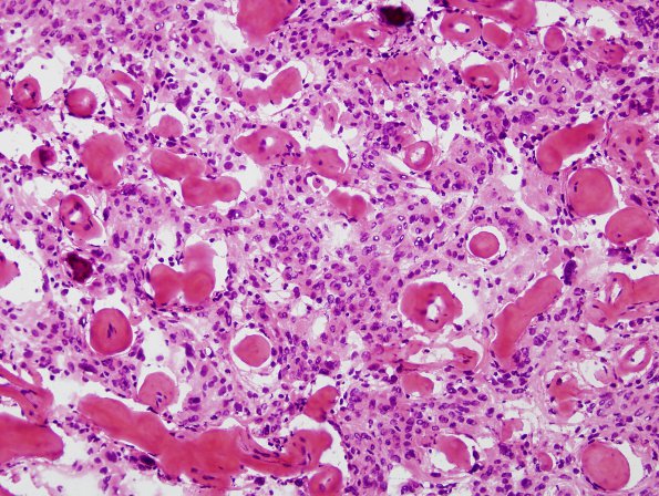 11B9 Meningioma (Case 11) H&E 9