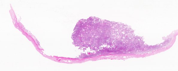 12A1 Meningioma (Case 12)