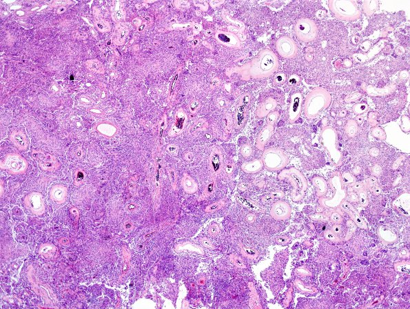 12A2 Meningioma, angiomatous (Case 12) H&E 2