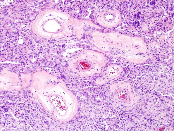 12A4 Meningioma, angiomatous (Case 12) H&E 4