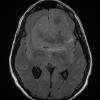 13A1 Meningioma (DDx SFT) (Case 13) FLAIR - Copy