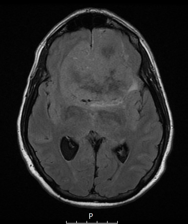 13A1 Meningioma (DDx SFT) (Case 13) FLAIR - Copy