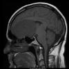 13A2 Meningioma (DDx SFT) (Case 13) T1noC sag - Copy