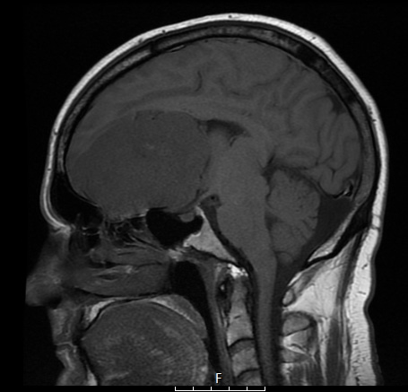 13A2 Meningioma (DDx SFT) (Case 13) T1noC sag - Copy