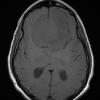 13A3 Meningioma (DDx SFT) (Case 13) T1noC axial - Copy