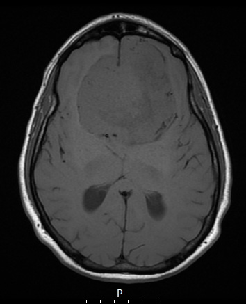 13A3 Meningioma (DDx SFT) (Case 13) T1noC axial - Copy