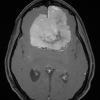 13A4 Meningioma (DDx SFT) (Case 13) T1W - Copy