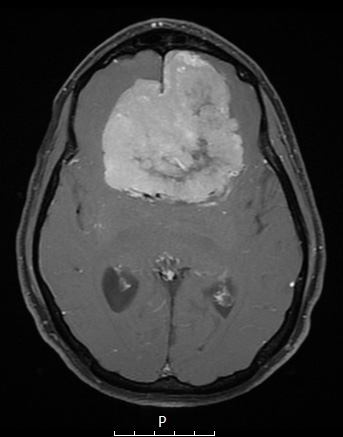 13A4 Meningioma (DDx SFT) (Case 13) T1W - Copy