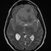 13A5 Meningioma (DDx SFT) (Case 13) FRFSE T2 no C - Copy