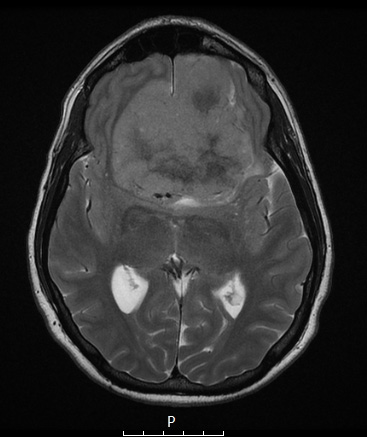 13A5 Meningioma (DDx SFT) (Case 13) FRFSE T2 no C - Copy