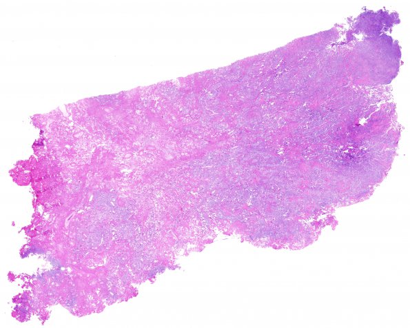 13B1 Meningioma, Angiomatous, Sclerosing WHO (Case 13) H&E WM