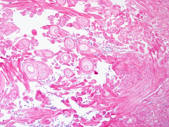 13B2 Meningioma (DDx SFT) (Case 13) H&E 7.jpg