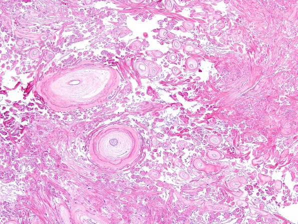 13B3 Meningioma (DDx SFT) (Case 13) H&E 8.jpg