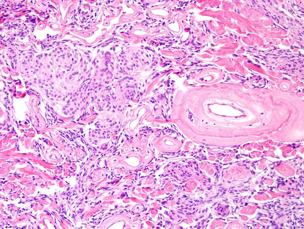 13B4 Meningioma (DDx SFT) (Case 13) H&E 3.jpg