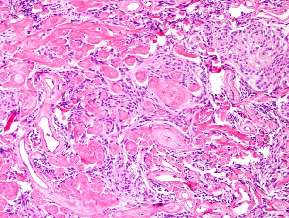 13B5 Meningioma (DDx SFT) (Case 13) H&E 4.jpg