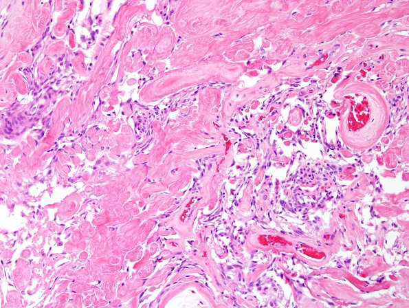 13B6 Meningioma (DDx SFT) (Case 13) H&E 5.jpg