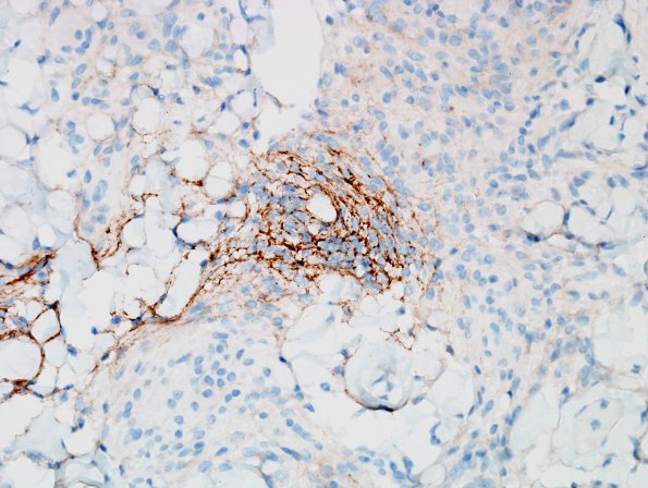 13C1 Meningioma (DDx SFT) (Case 13) EMA 1.jpg