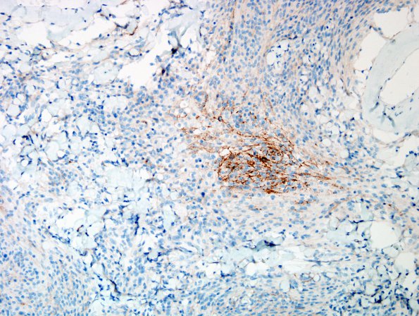 13C2 Meningioma (DDx SFT) (Case 13) EMA 2.jpg