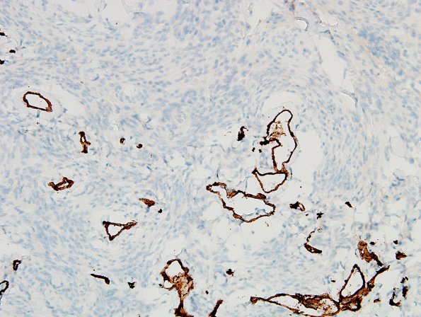 13D Meningioma (DDx SFT) (Case 13) CD34 3.jpg