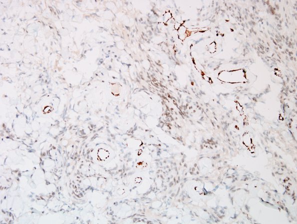 13E Meningioma (DDx SFT) (Case 13) SMA 2.jpg