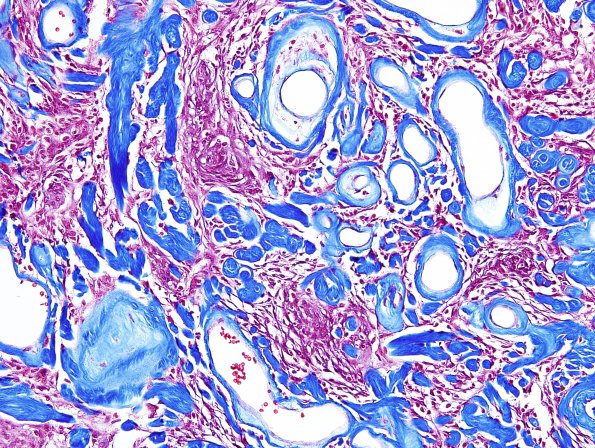 13F3 Meningioma (DDx SFT) (Case 13) Trichrome 1.jpg