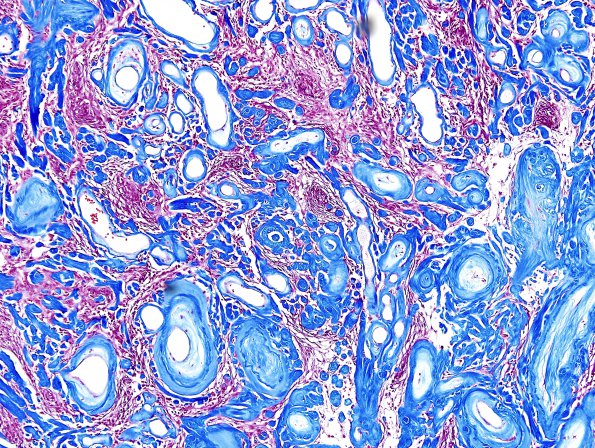 13F4 Meningioma (DDx SFT) (Case 13) Trichrome 2.jpg