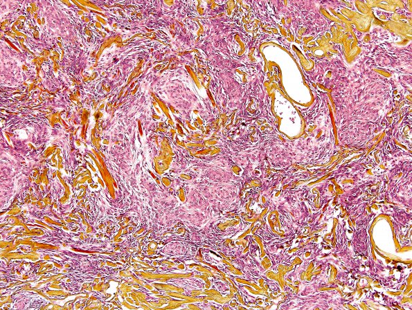 13G1 Meningioma (DDx SFT) (Case 13) Pentachrome 1.jpg