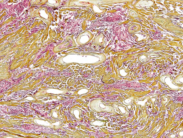 13G2 Meningioma (DDx SFT) (Case 13) Pentachrome 3.jpg