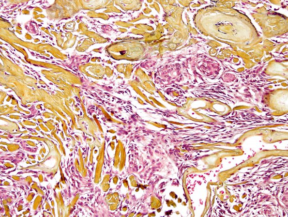 13G3 Meningioma (DDx SFT) (Case 13) Pentachrome 2.jpg