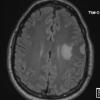 14A1 Meningioma, EMA negative (Case 14) FLAIR - Copy