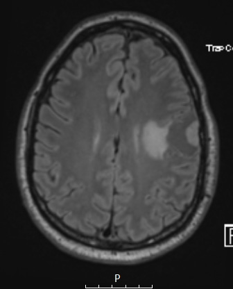 14A1 Meningioma, EMA negative (Case 14) FLAIR - Copy