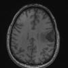 14A2 Meningioma, EMA negative (Case 14) T1noC - Copy