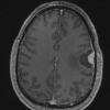 14A3 Meningioma, EMA negative (Case 14) T1W - Copy