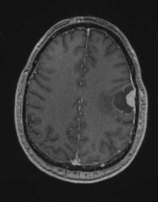 14A3 Meningioma, EMA negative (Case 14) T1W - Copy