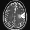 14A4 Meningioma, EMA negative (Case 14) T2W - Copy