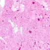 14B1 Meningioma, EMA negative (Case 14) H&E 3