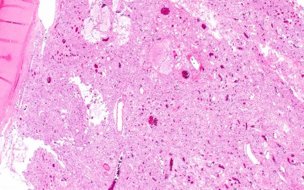 14B1 Meningioma, EMA negative (Case 14) H&E 3