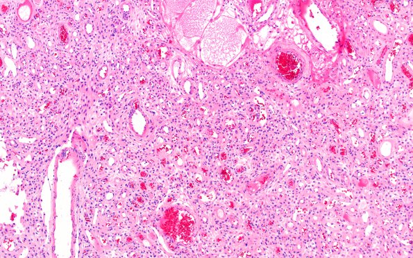 14B2 Meningioma, EMA negative (Case 14) H&E 2