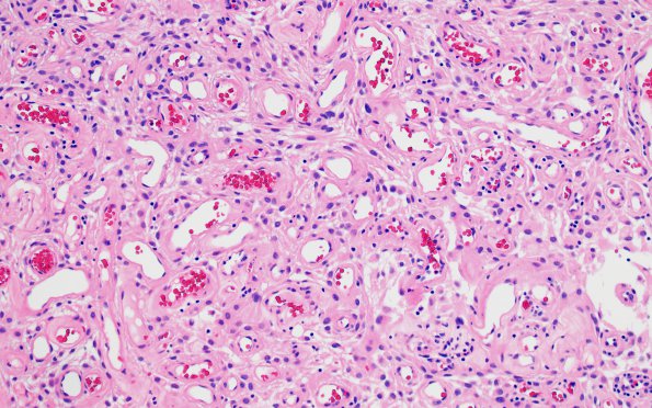 14B4 Meningioma, EMA negative (Case 14) H&E prompting negative Inhibin