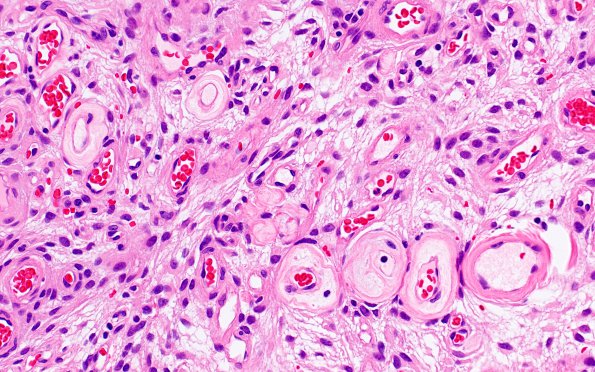 14B5 Meningioma, EMA negative (Case 14) H&E angiomatous (2)