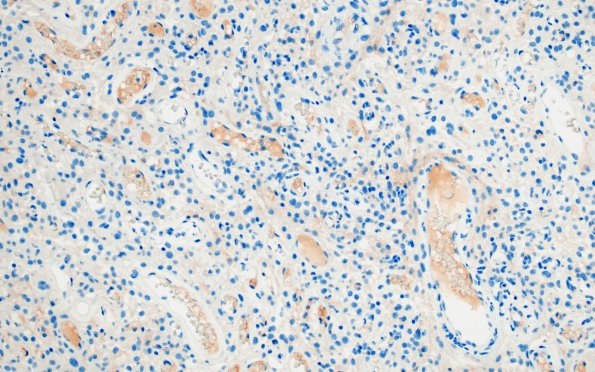 14C2 Meningioma, EMA negative (Case 14) EMA 1