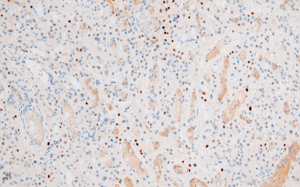 14D Meningioma, EMA negative (Case 14) PR 1