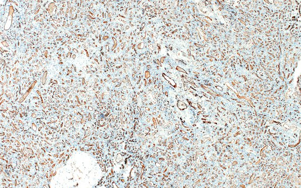 14E1 Meningioma, EMA negative (Case 14) CD31 1