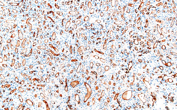 14E2 Meningioma, EMA negative (Case 14) CD31 3