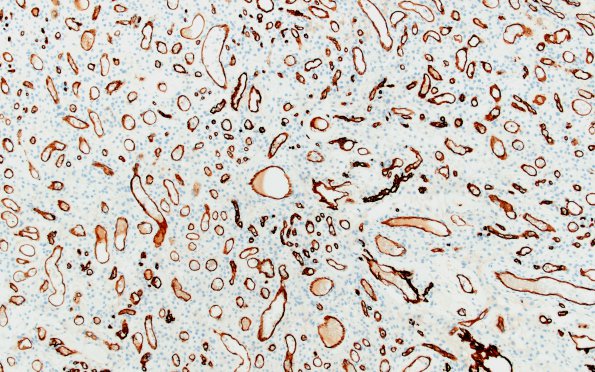 14F2 Meningioma, EMA negative (Case 14) CD34 2