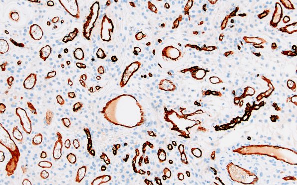 14F3 Meningioma, EMA negative (Case 14) CD34 1