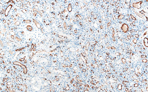 14G1 Meningioma, EMA negative (Case 14) SMA 2