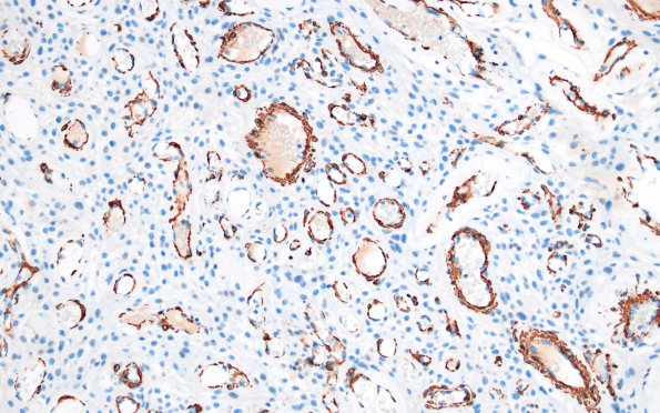 14G2 Meningioma, EMA negative (Case 14) SMA 1